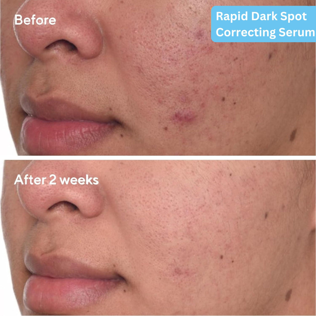 SKINLUV DARK SPOT CORRECTING SERUM With Niacinamide 30ml