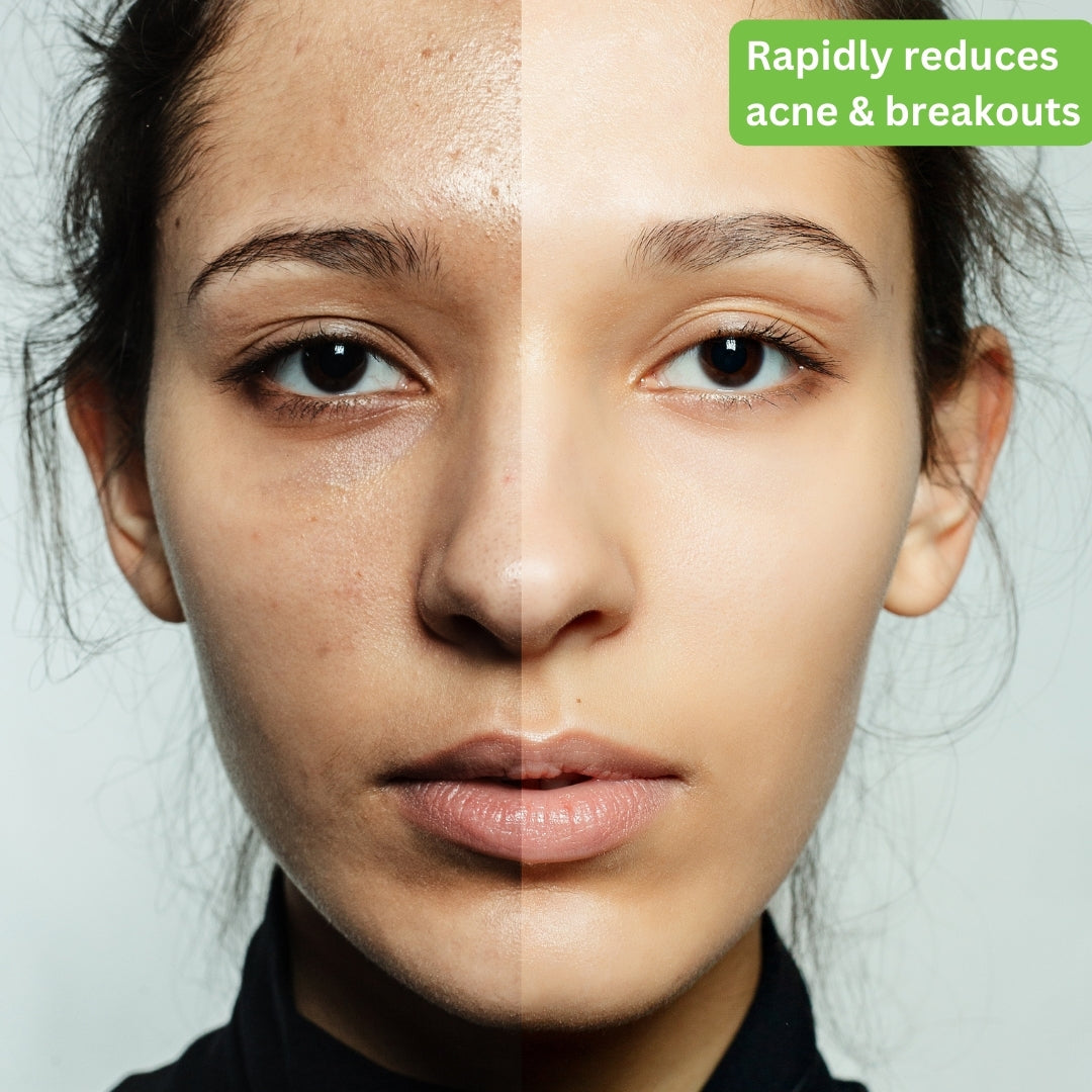 SKINLUV CLINIFY FACE SERUM 30ml + SKINLUV Clinify Anti Acne Facewash Combo