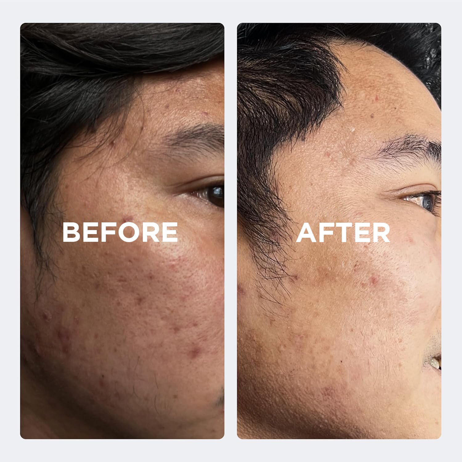 SKINLUV CLINIFY Salicylic acid -Anti Acne Face Serum 30ml