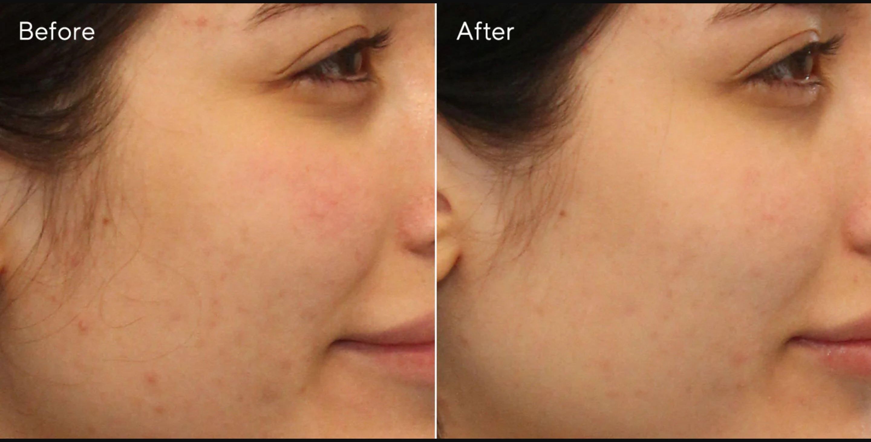 SKINLUV CLINIFY FACE SERUM 30ml + SKINLUV Clinify Anti Acne Facewash Combo